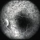 Recurrent Pseudotumor with Scleritis